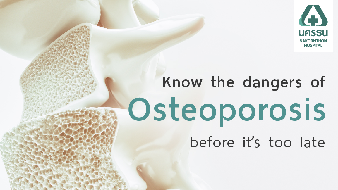 Osteoporosis Don't wait for the line to start preventing it at a young age.